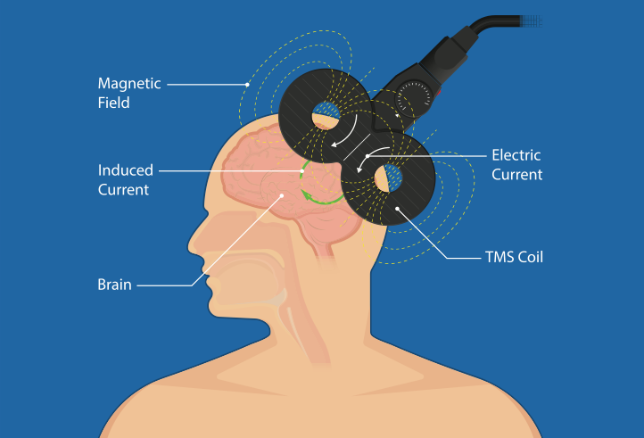 brain mapping procedure tms